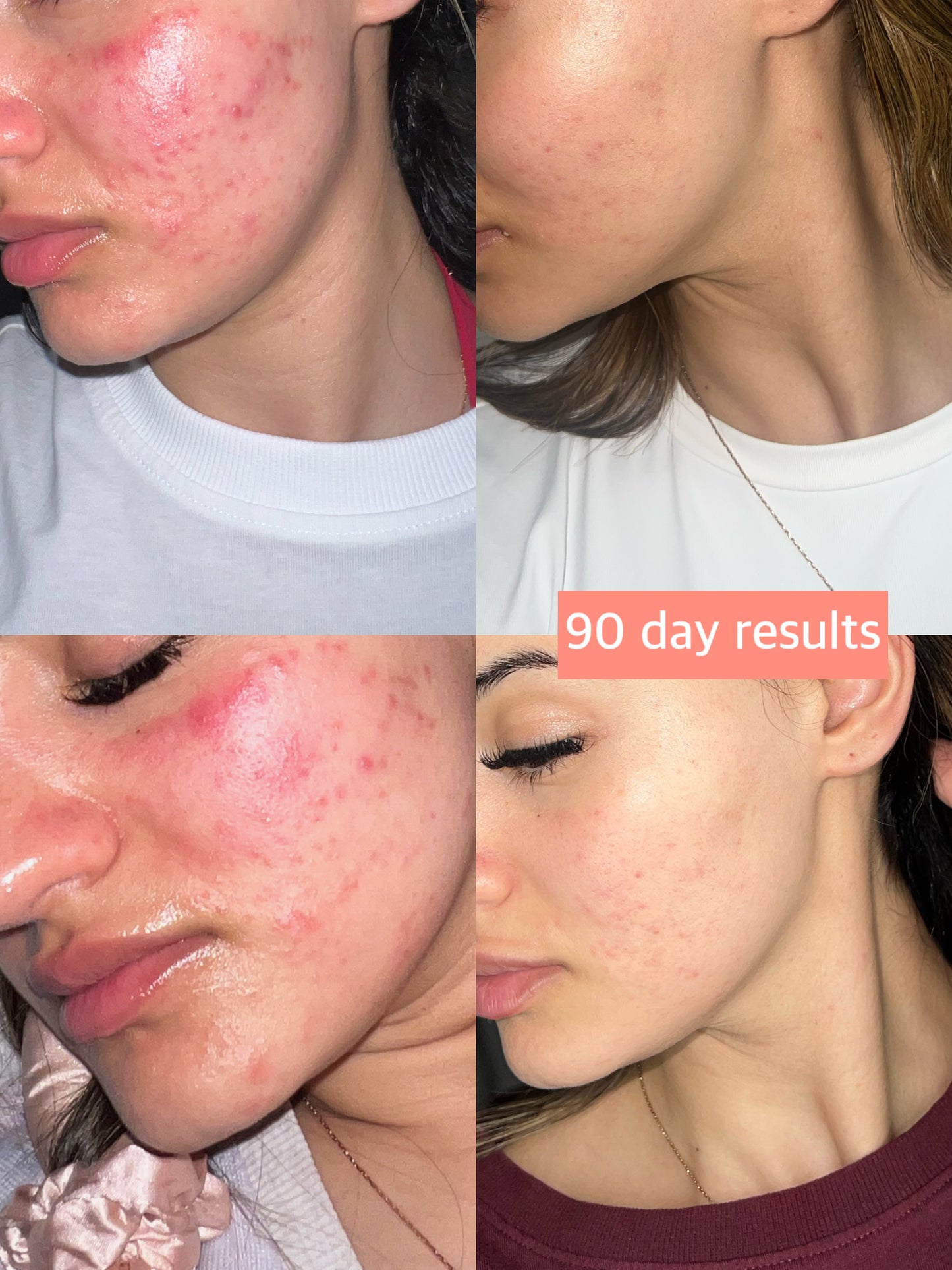 Alma Skin™ - Near Infrared Light Therapy Mask