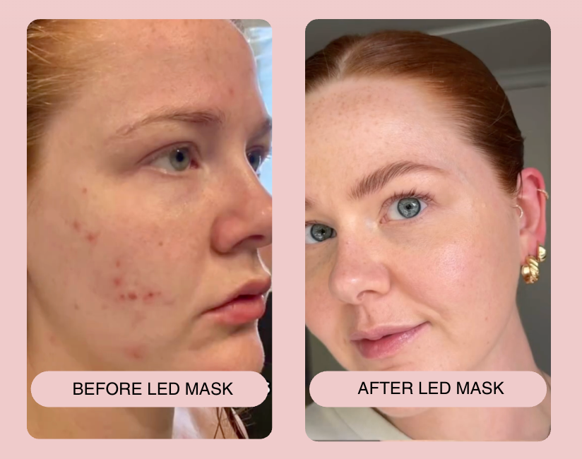 Alma Skin™ - Near Infrared Light Therapy Mask