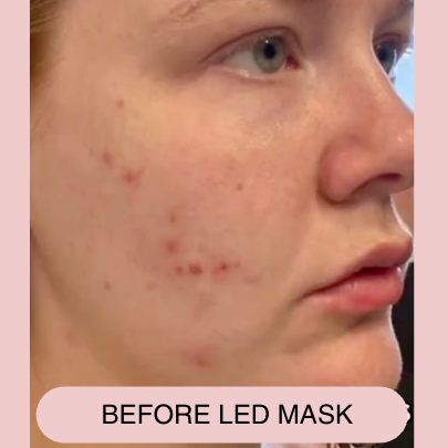 Alma Skin™ - Near Infrared Light Therapy Mask